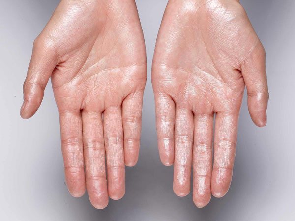 hyperhidrosis