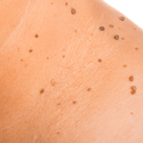 mole eart corn removal