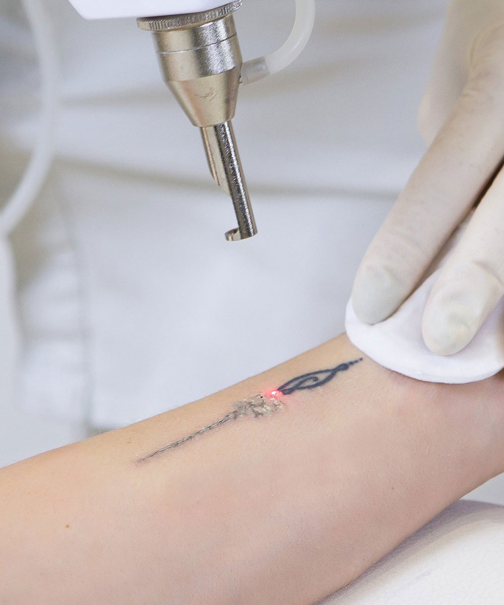tatto removal